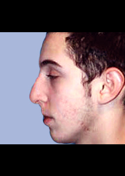 Rhinoplasty – Case 8