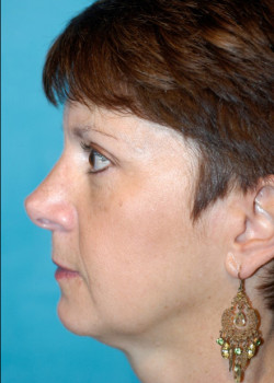 Facelift Patient – Case 21