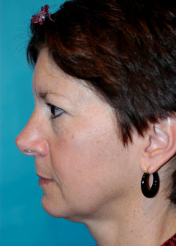 Facelift Patient – Case 21