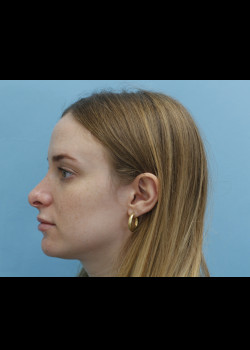 Revision Rhinoplasty – Case 11