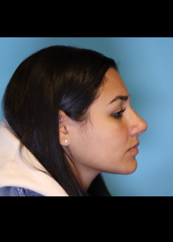 Rhinoplasty – Case 26