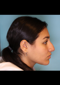 Rhinoplasty – Case 26