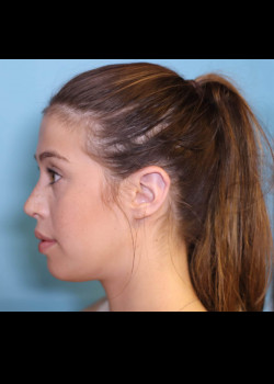 Rhinoplasty – Case 27