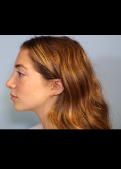 Rhinoplasty – Case 28