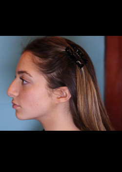 Rhinoplasty – Case 28