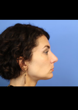 Female Facial Implant- Case 7