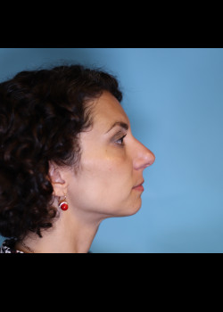 Female Facial Implant- Case 7