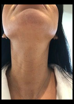 platysmaplasty for women – Case 1