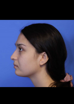 Chin Implant