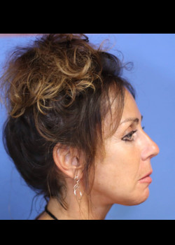 Facelift and Platysmaplasty