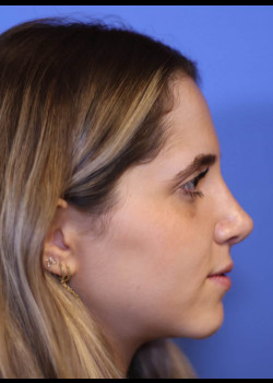 Reduction Structured Rhinoplasty – Case 1