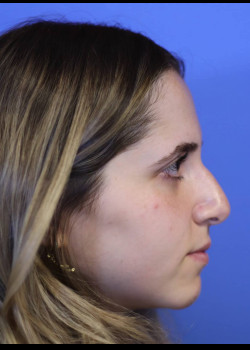 Reduction Structured Rhinoplasty – Case 1