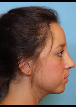 Reduction Structured Rhinoplasty – Case 2