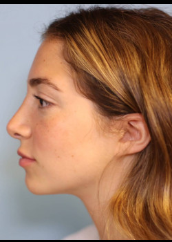 Reduction Structured Rhinoplasty – Case 3