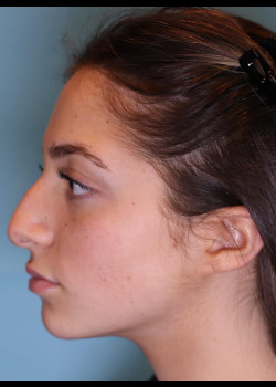 Reduction Structured Rhinoplasty – Case 3