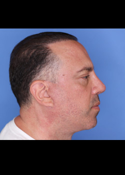 Revision Rhinoplasty