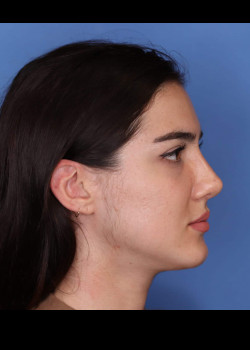 Revision Rhinoplasty