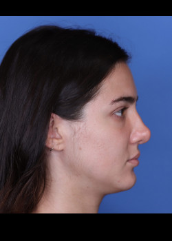 Revision Rhinoplasty