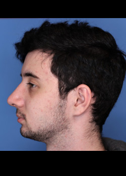 Male Rhinoplasty