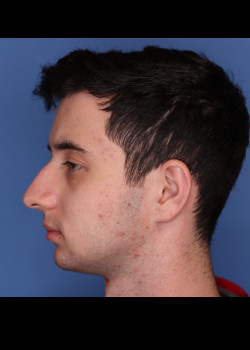 Male Rhinoplasty