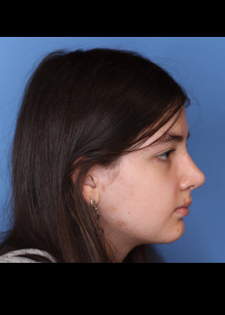 Female Rhinoplasty