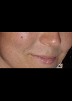 Dermal Fillers