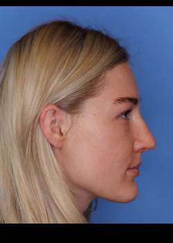 Female Rhinoplasty