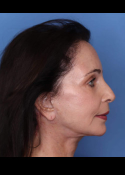 Female Facelift