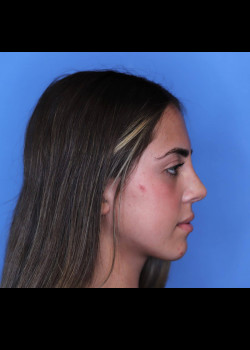 Female Rhinoplasty