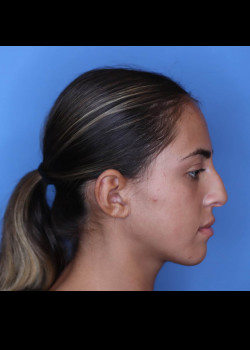 Female Rhinoplasty