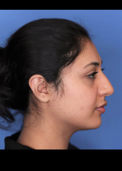 Female Rhinoplasty