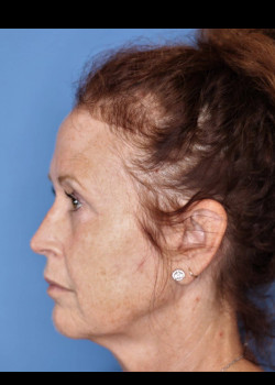 Female Blepharoplasty