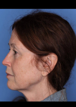 Female Blepharoplasty