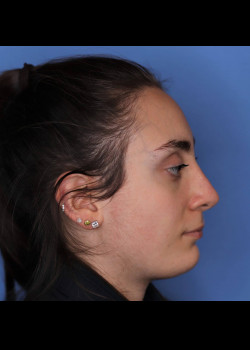 Female Rhinoplasty