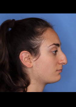 Female Rhinoplasty