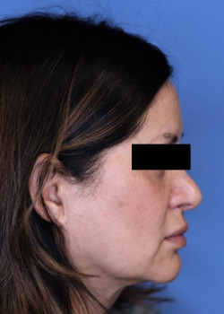 Revision Rhinoplasty