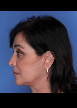 Female Facelift