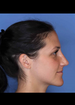 Rhinoplasty