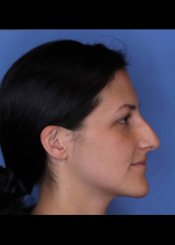 Rhinoplasty