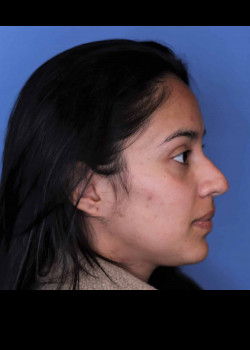 Rhinoplasty