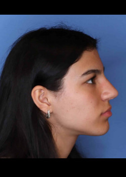 Rhinoplasty