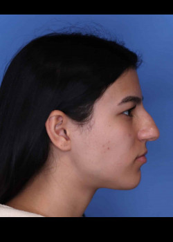 Rhinoplasty