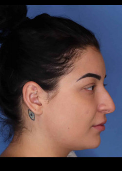 Rhinoplasty