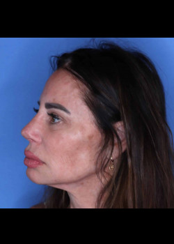 Female Rhinoplasty