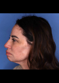 Female Rhinoplasty