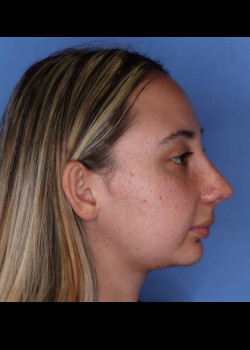 Rhinoplasty