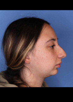 Rhinoplasty