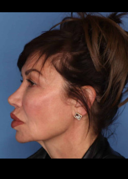 Revision Rhinoplasty