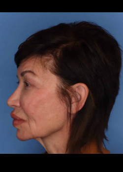 Revision Rhinoplasty