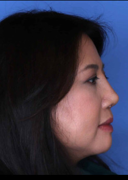Revision Rhinoplasty